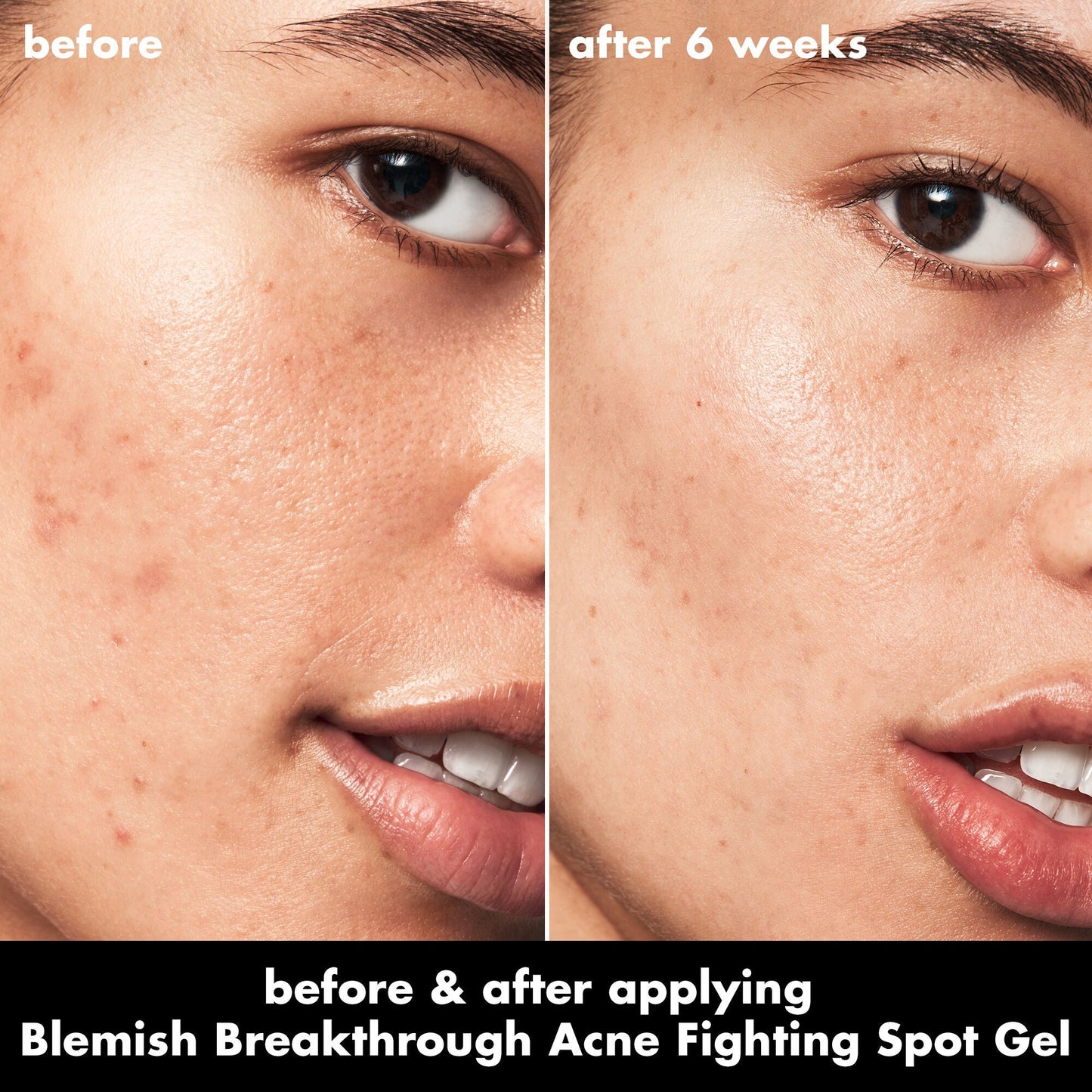 blemish-breakthrough-acne-fighting-spot-gel-r2 0326_EDU_BB_SpotGel_BA_ISABELLA.jpg