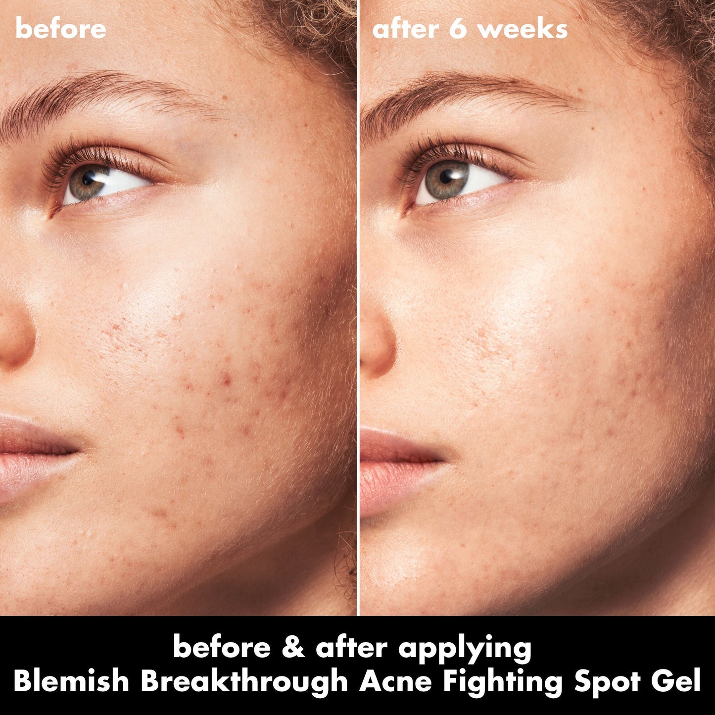 blemish-breakthrough-acne-fighting-spot-gel-r2 0326_EDU_BB_SpotGel_BA_MARLEY.jpg