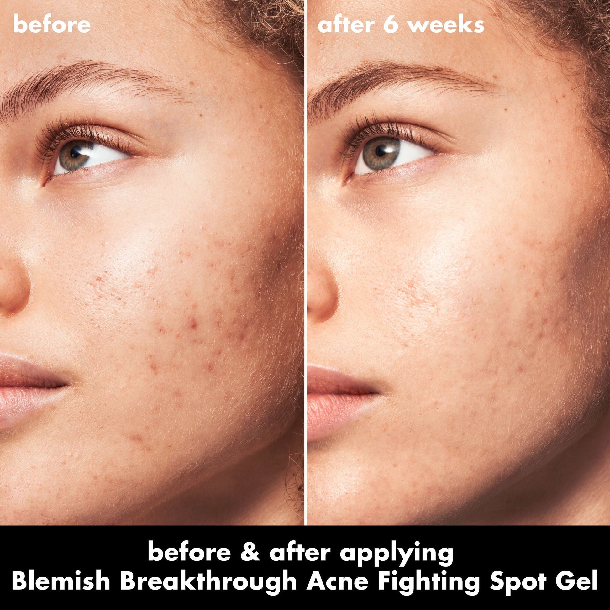 blemish-breakthrough-acne-fighting-spot-gel-r2 0326_EDU_BB_SpotGel_BA_MARLEY.jpg