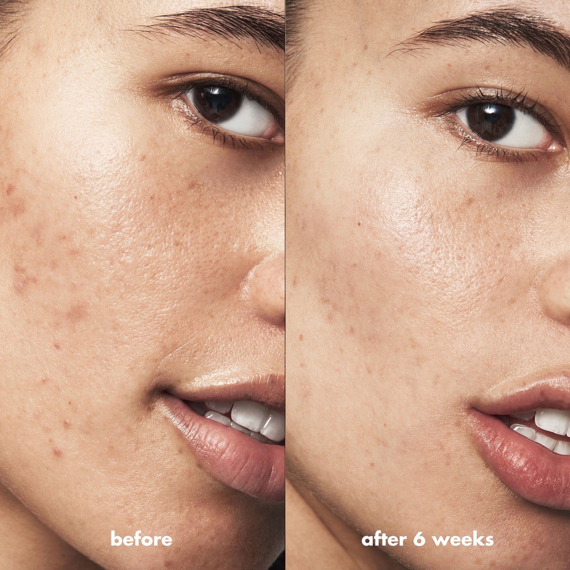 blemish-breakthrough-acne-calming-water-cream-mini-d8 Acne_PDP_Isabella_Before_After_f0d452cd-72f5-4bb8-a6df-0b3cc23143ef.jpg