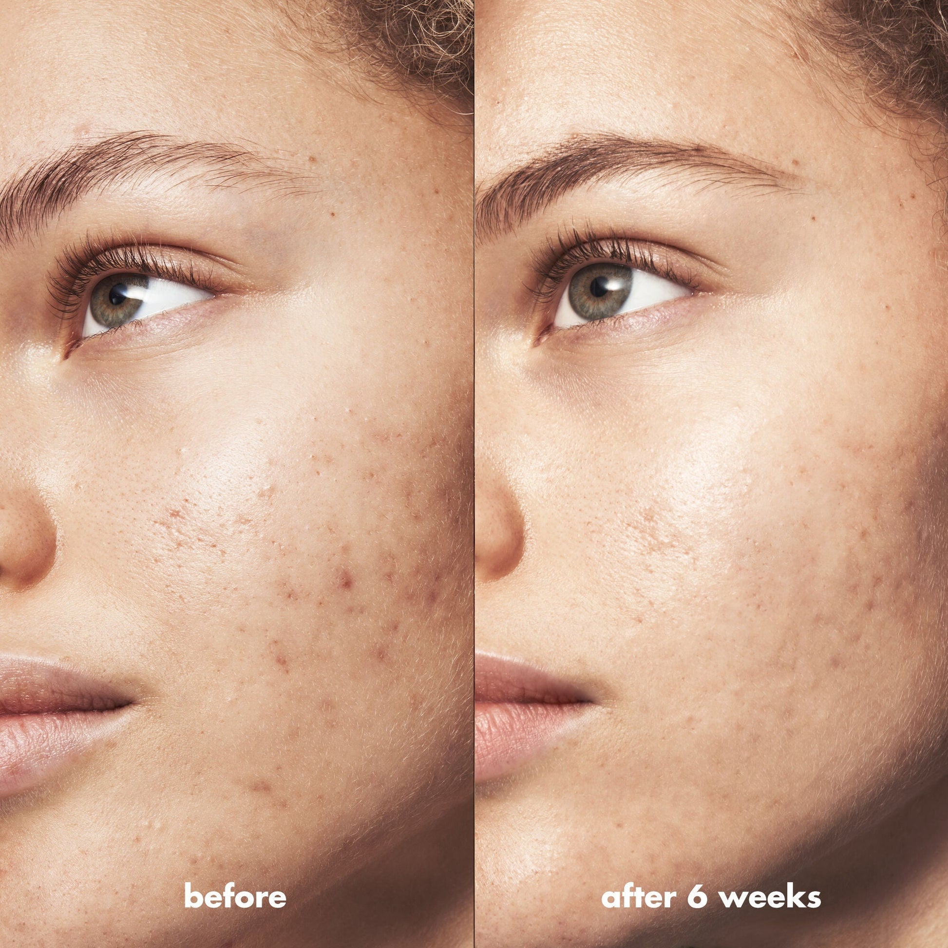 blemish-breakthrough-triple-acid-resurfacing-serum-y5 Acne_PDP_Marley_Before_After_1a95cac5-0af6-43b6-a936-d0bacbdec0bf.jpg
